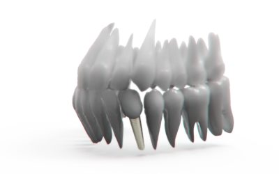 Implantatversorgung