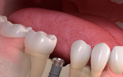 Implantat Privatsprechstunde am Wochenende