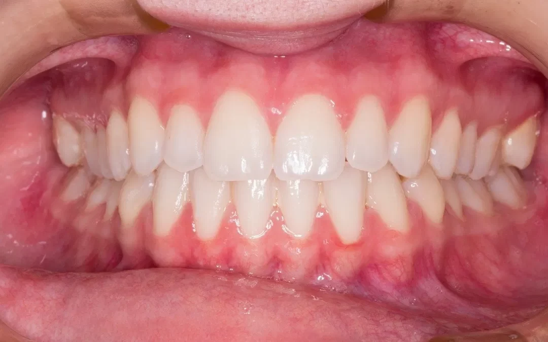 BTX gegen Zähneknirschen