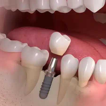 Implant-borne_single-tooth_treatment_03_ergebnis_ergebnis800_450 Zahnimplantat München