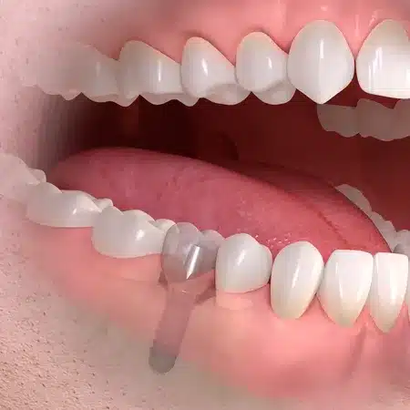Implant-borne_single-tooth_treatment_04_ergebnis_ergebnis800_450