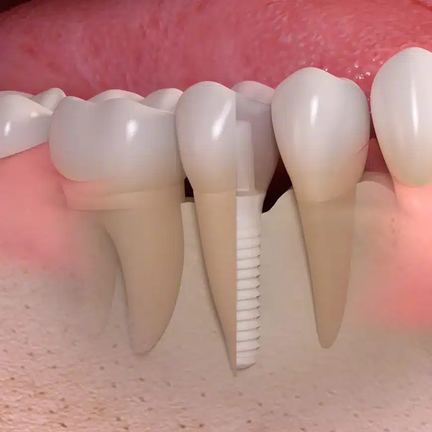 Side_cut_of_ceramic_implant_02_ergebnis Zahnimplantat München